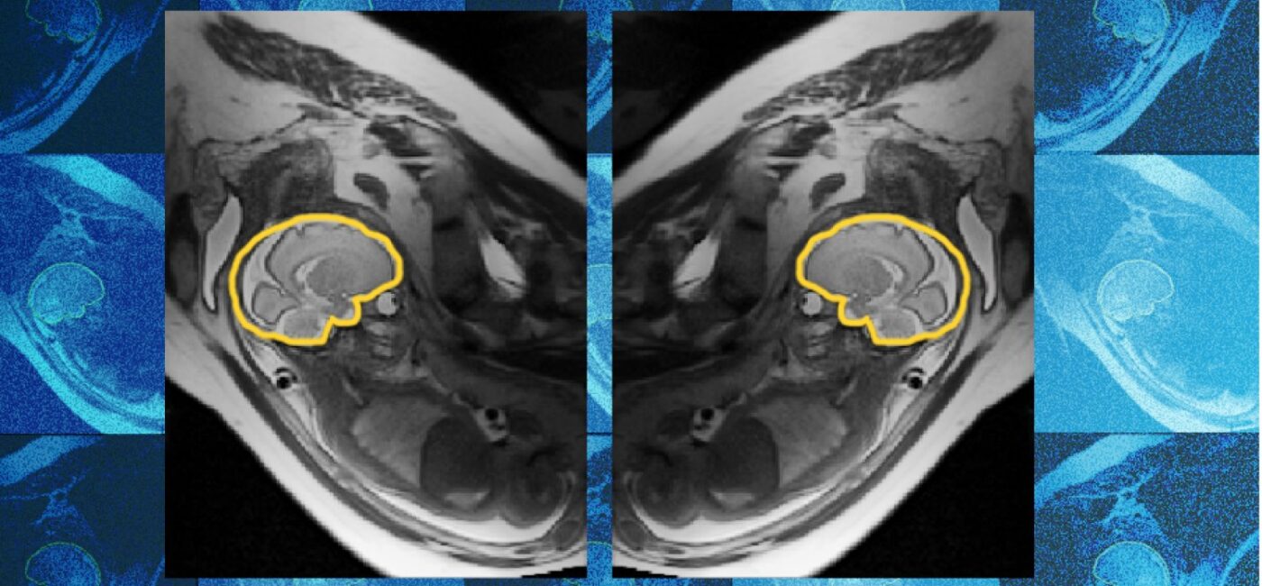 Why teaching AI about symmetry could make prenatal diagnosis more reliable | MIT News